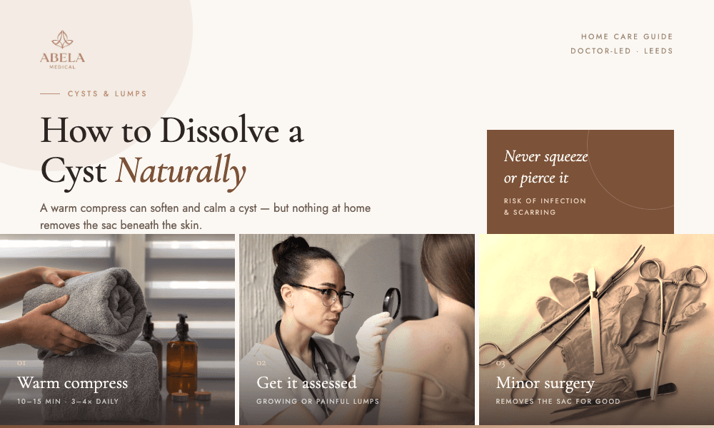 How to Dissolve a Cyst Naturally: Safe Home Care Guide