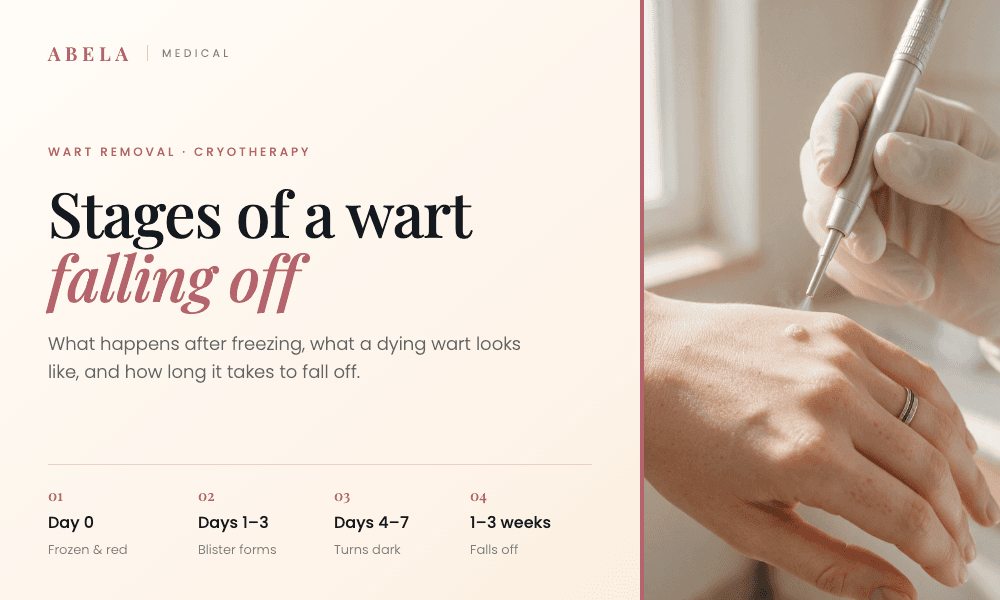 Stages of a wart falling off, explained by Abela Medical