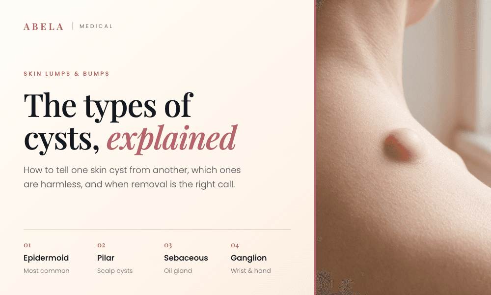 Types of Cysts: Which Skin Lumps You Should Never Ignore